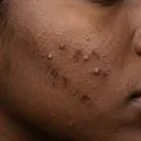 Dark skin texture with mild breakout
