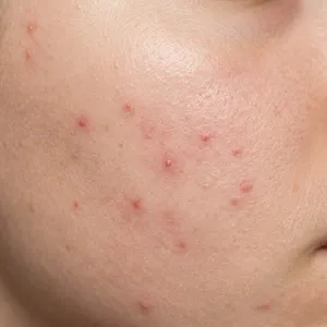 Light skin texture with mild breakout