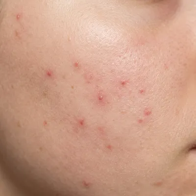 Light skin texture with mild breakout