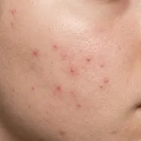 Light skin texture with mild breakout