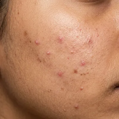 Medium skin texture with mild breakout