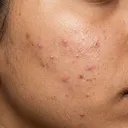 Medium skin texture with mild breakout