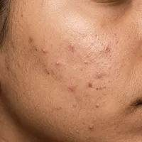 Medium skin texture with mild breakout