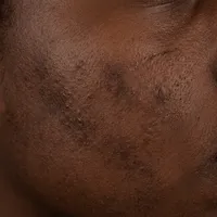 Dark skin texture recovering from breakout
