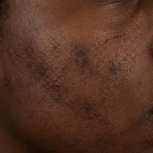 Dark skin texture recovering from breakout