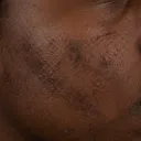 Dark skin texture recovering from breakout