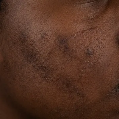 Dark skin texture recovering from breakout