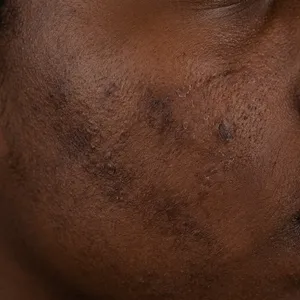 Dark skin texture recovering from breakout