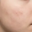 Light skin texture recovering from breakout