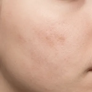 Light skin texture recovering from breakout