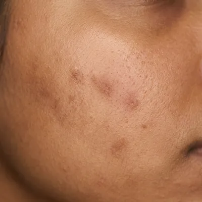 Medium skin texture recovering from breakout