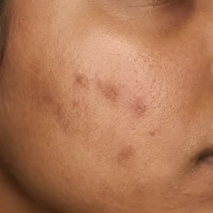 Medium skin texture recovering from breakout