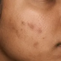 Medium skin texture recovering from breakout