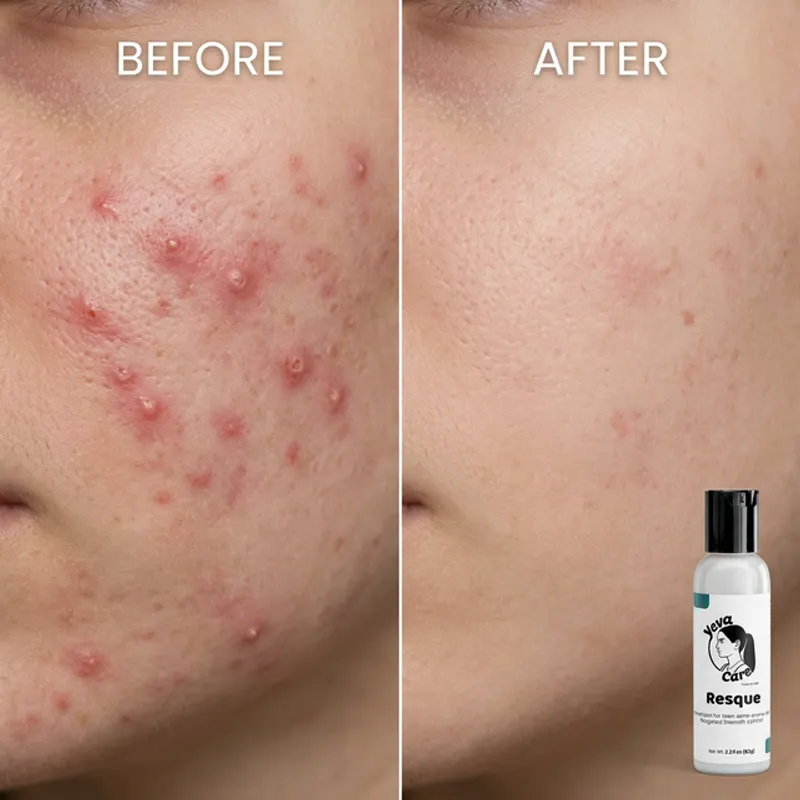 Before and after results using Yeva Rescue on active breakouts