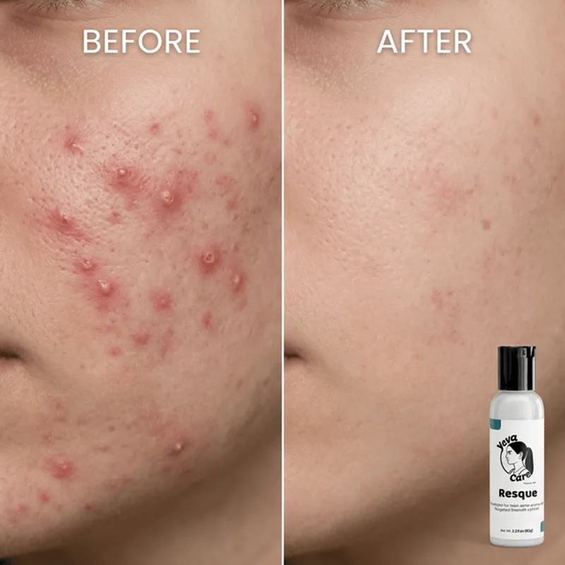 Before and after results using Yeva Rescue on active breakouts