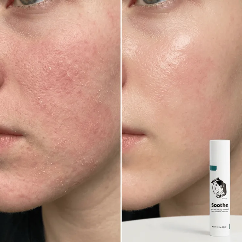 Before and after results using Yeva Soothe to restore skin balance