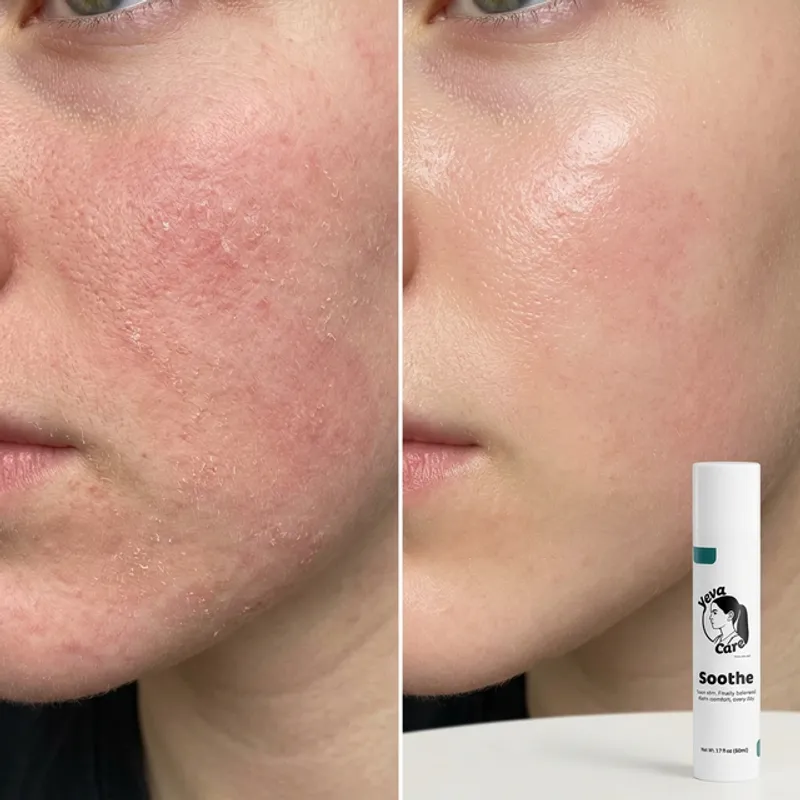 Before and after results using Yeva Soothe to restore skin balance