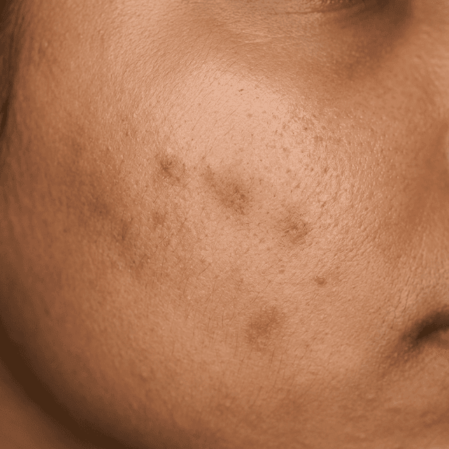 Medium skin texture recovering from breakout